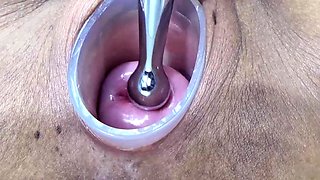 Japanese Wife Open Cervix Wide to watch inside Uterus