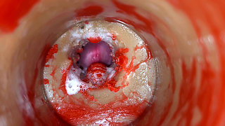 Insemination - Internal Camera Captures Deep Male Ejaculation